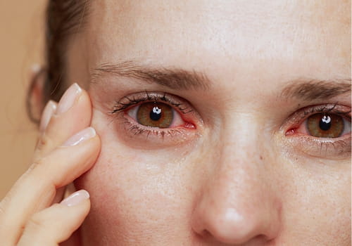 Mujer con sequedad ocular